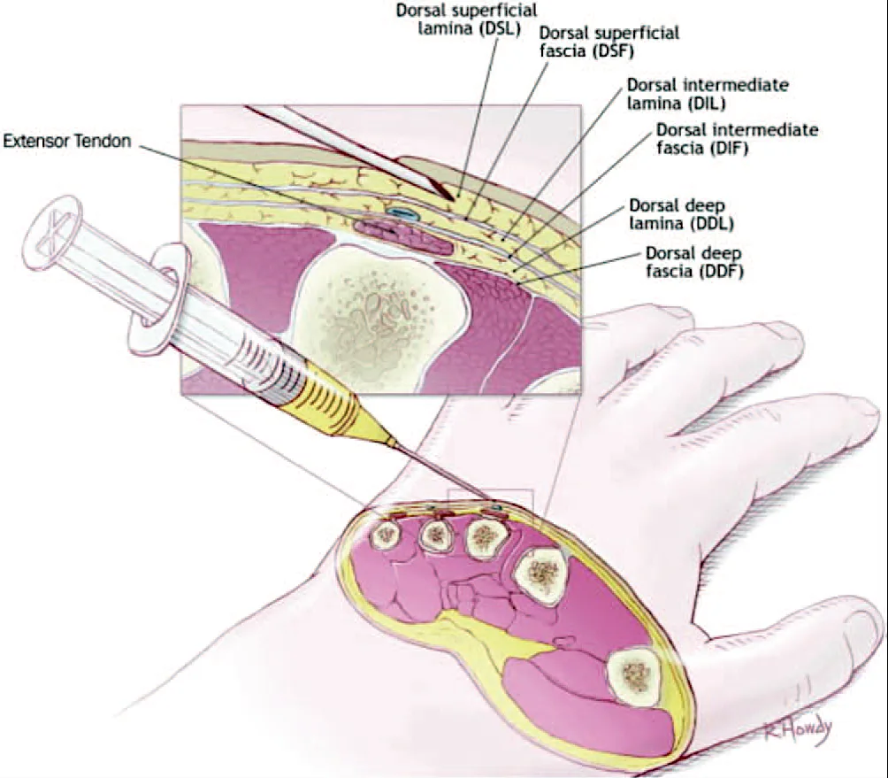 Fig 19. Fascial laminae of the dorsum of the hand and injection plane