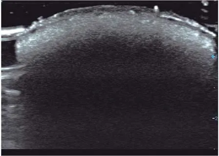 Fig 20. "Snowstorm" ultrasound pattern of a permanent filler
