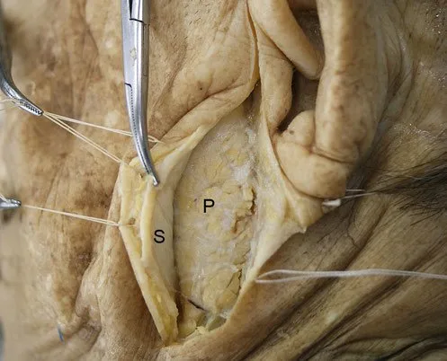 Fig 1. SMAS elevated with traction points over the parotid plane