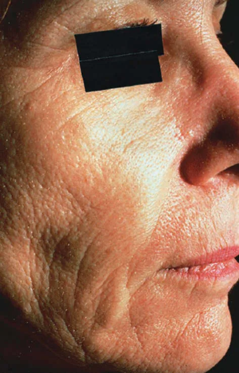 Fig 8. Clinical photoaging: coarse deep rhytides and dyschromia in a severely sun-damaged face.