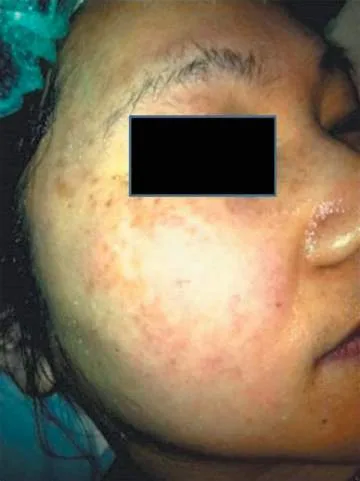 Fig 10. Malar melasma: symmetric brown macular hyperpigmentation on the cheek.