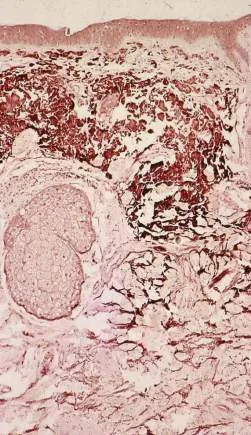 Fig 7. Histology of photoaged skin with basophilic solar elastosis in the upper dermis.