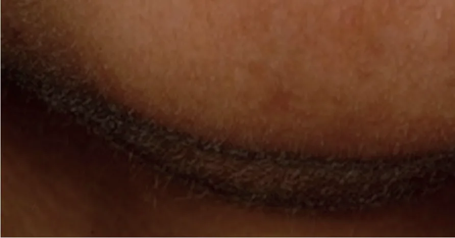 Fig 11. Post-inflammatory hyperpigmentation: a well-defined brown macular band on the skin.