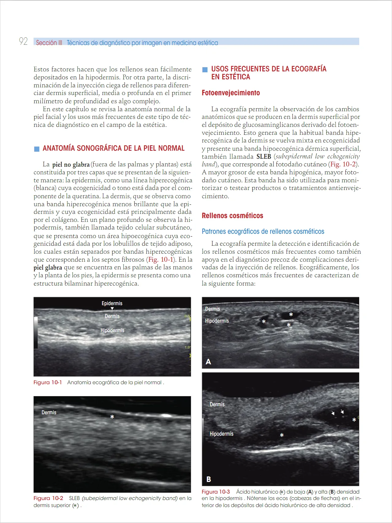 Fig 11. Patrones ecográficos del ácido hialurónico en la hipodermis