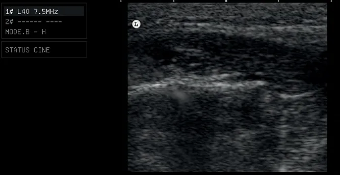 Fig 11. Ultrasound appearance of the poly-lactic acid / polycaprolactone deposit