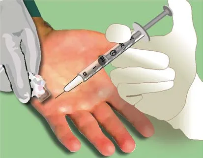 Fig 17. Ilustración de una inyección intradérmica en la palma de la mano, con la jeringa de insulina sostenida casi paralela a la piel.