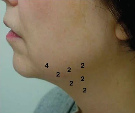 Fig 16. Perfil de una paciente con los puntos de inyección y las unidades escritas sobre la piel de la región mandibular y cervical alta.