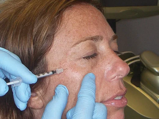 Fig 14. Inyección en la región del canto lateral con jeringa de insulina, con la piel estabilizada por la mano contraria del inyector.