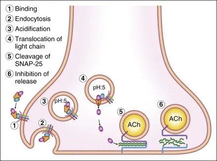 Fig 4. Los seis pasos de la quimiodenervación en la unión neuromuscular