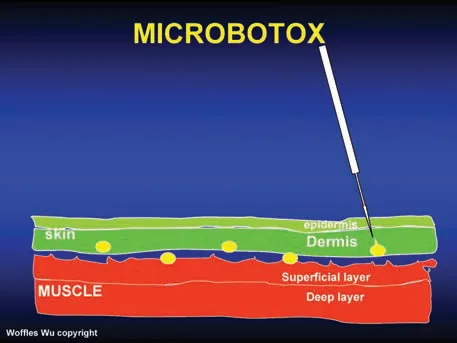 Fig 10. El plano del microbotox: dermis y capa muscular superficial, no el vientre del músculo