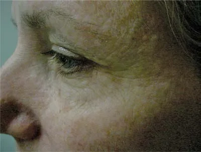 Fig 12. Región periorbitaria tras tratamiento con onabotulinumtoxinA, en el contexto de una ptosis de ceja documentada