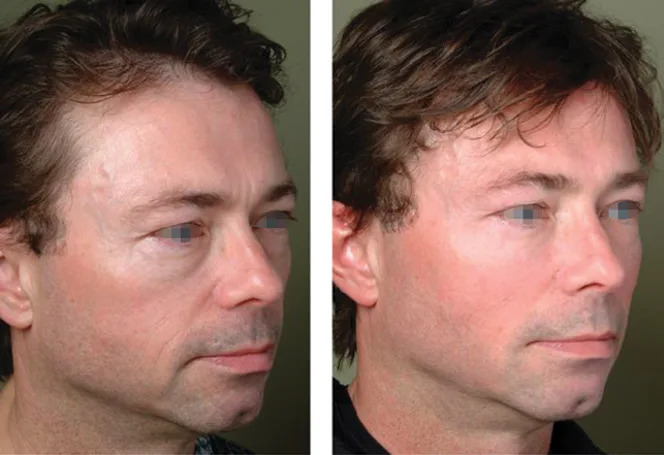 Fig 10. Phi-point construction of the cheek in the oblique view