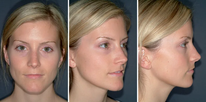 Fig 3. Standard positioning for full facial photography — frontal, oblique and profile