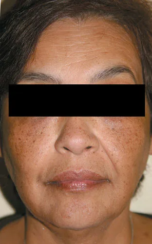 Fig 12. Facial dyschromia in skin of color — the pigmentary risk that governs energy and peel choices