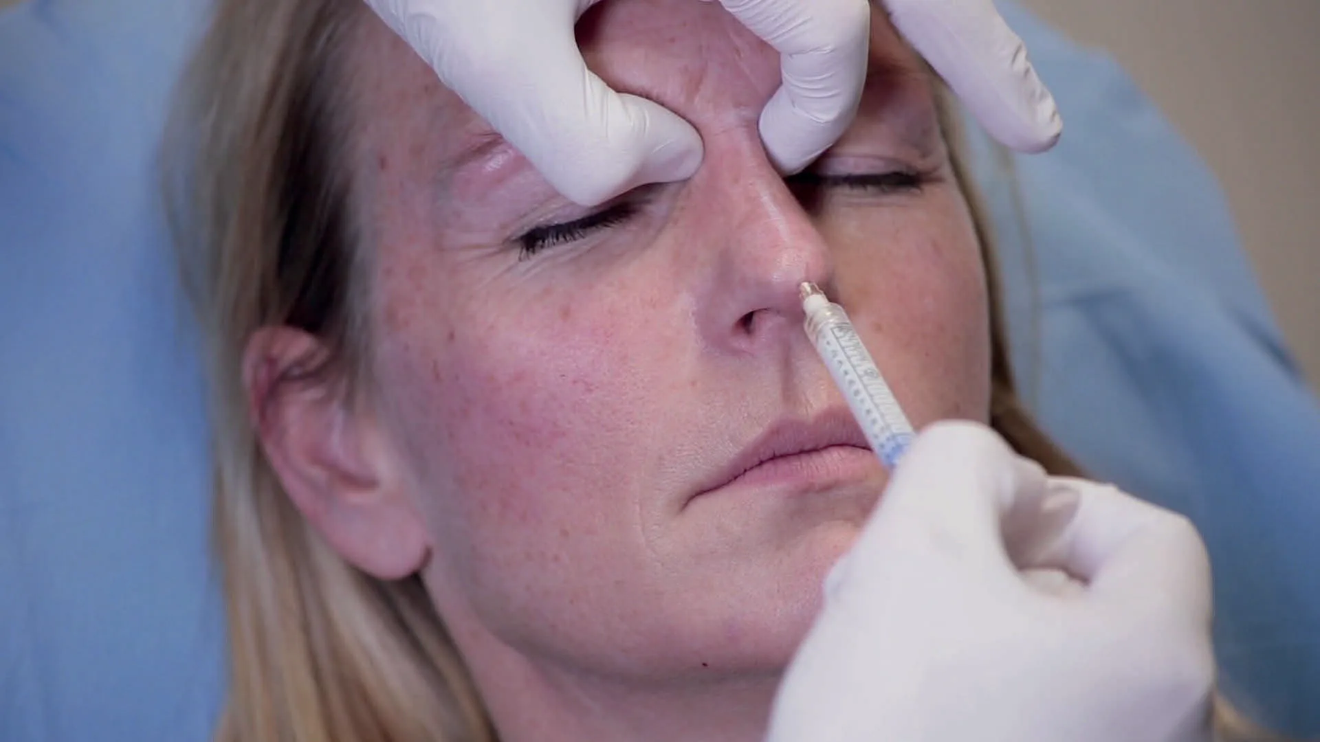 Fig 5. A high-risk region: the nasal tip