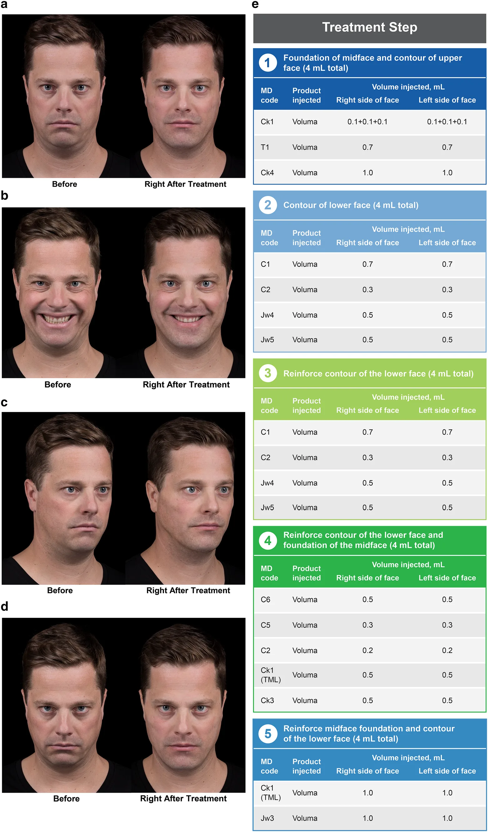 Fig 1. MD Codes five-step full-face plan with per-code volumes