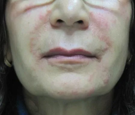Fig 4. Erythematous hypersensitivity-pattern cutaneous reaction across the mid and lower face following an injectable procedure.