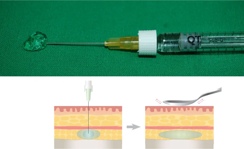Fig 4. Bolus injection: tinted depot at the needle tip (top); deep depot deposited then molded (bottom).