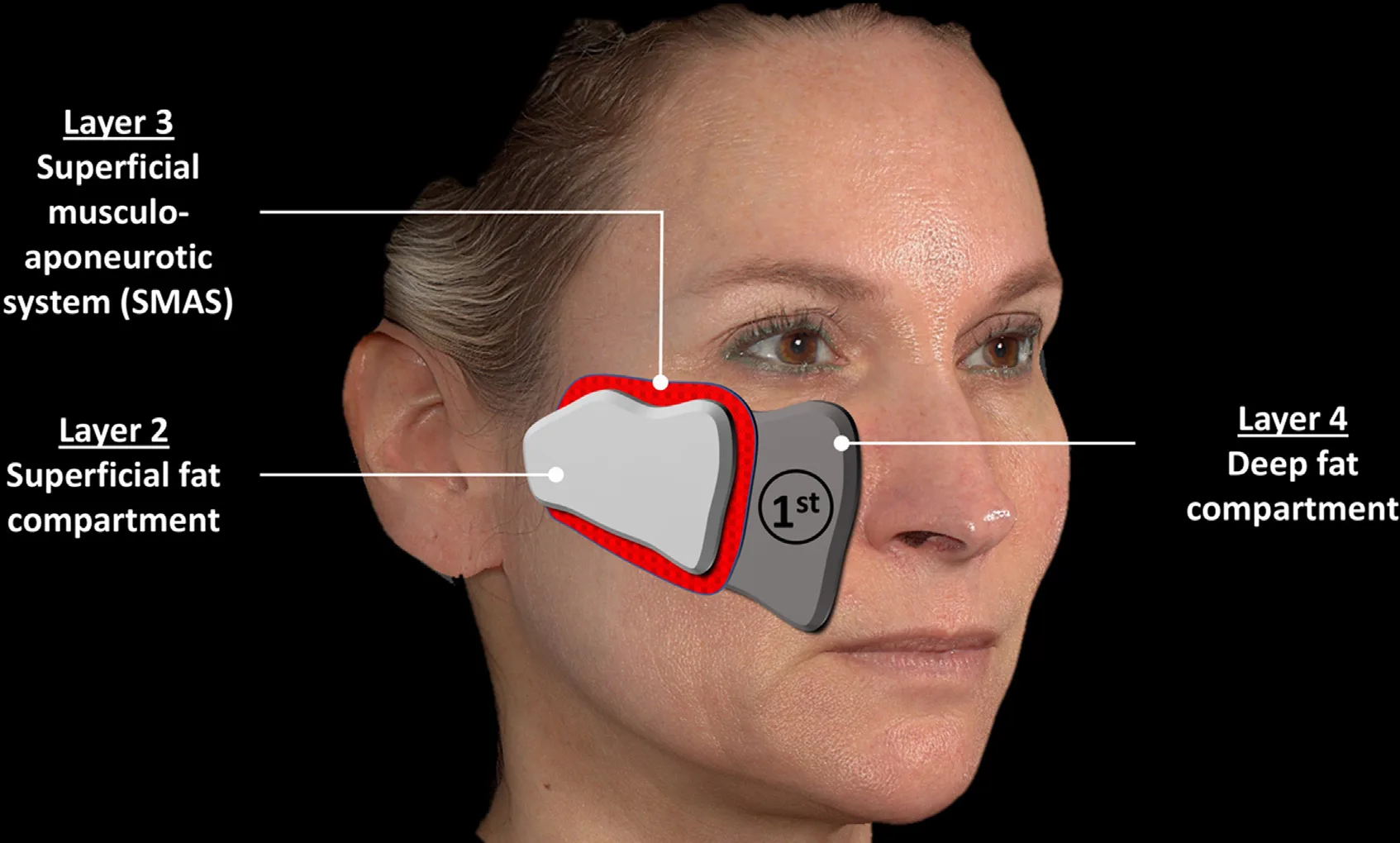 Fig 2. Facial layer scaffold: layer 2 superficial fat, layer 3 SMAS, layer 4 deep fat marked "1st" (deep injections first).