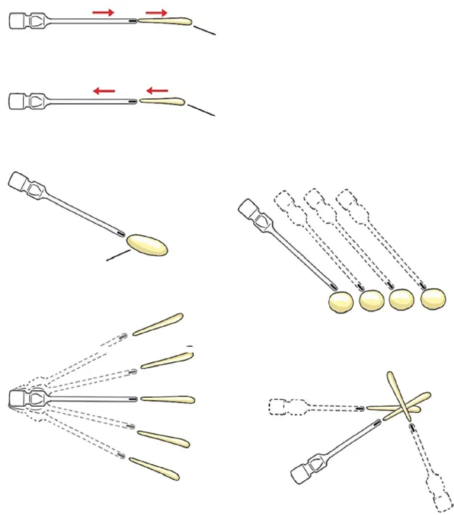 Fig 3. Injection movements: anterograde/retrograde threading, depot, serial puncture, fanning, cross-hatch.
