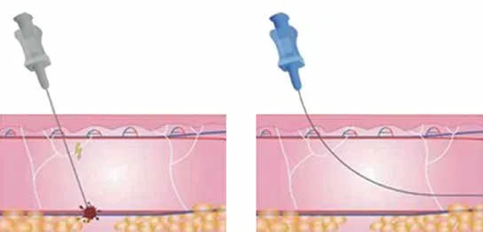 Fig 1. Sharp needle punctures a subcutaneous vessel (left); blunt cannula bends and displaces along the plane (right).
