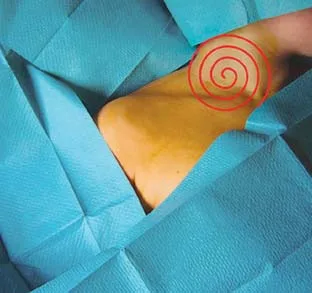 Fig 6. Skin antisepsis applied centre-to-periphery over a draped field (spiral motion).