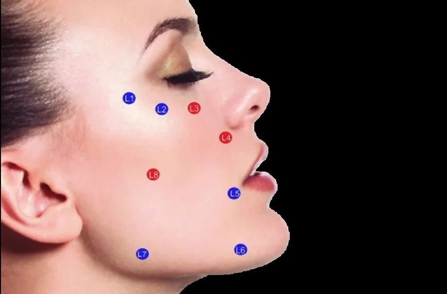 Fig 3. The 8-point lift plotted as L1–L8 on a profile view. Each L-point sits on a site that already carries an anatomy code: L1/L2 on the cheek, L3 (red) anteromedial, L4 (red) nasolabial, L5 oral commissure, L6 prejowl, L7 mandible angle, L8 (red) submalar.