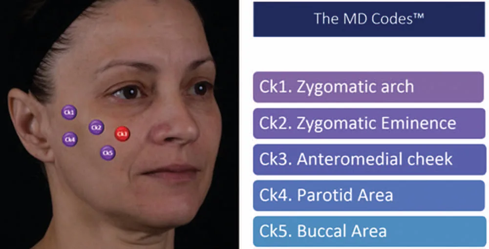 Fig 2. The MD Codes 5-point cheek reshape reproduced in a peer-reviewed anatomy paper: Ck1 zygomatic arch, Ck2 zygomatic eminence, Ck3 anteromedial cheek (red = alert), Ck4 parotid area, Ck5 buccal area.