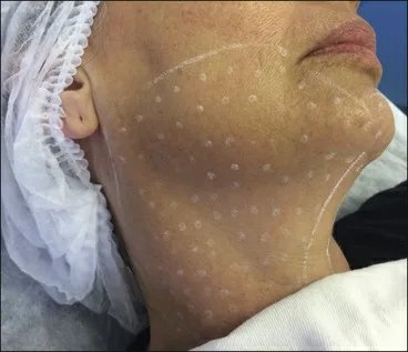 Fig 3. Microbotox/mesobotox marking: a dense grid of superficial micro-aliquot points across the lower face and neck, with the jawline outlined.
