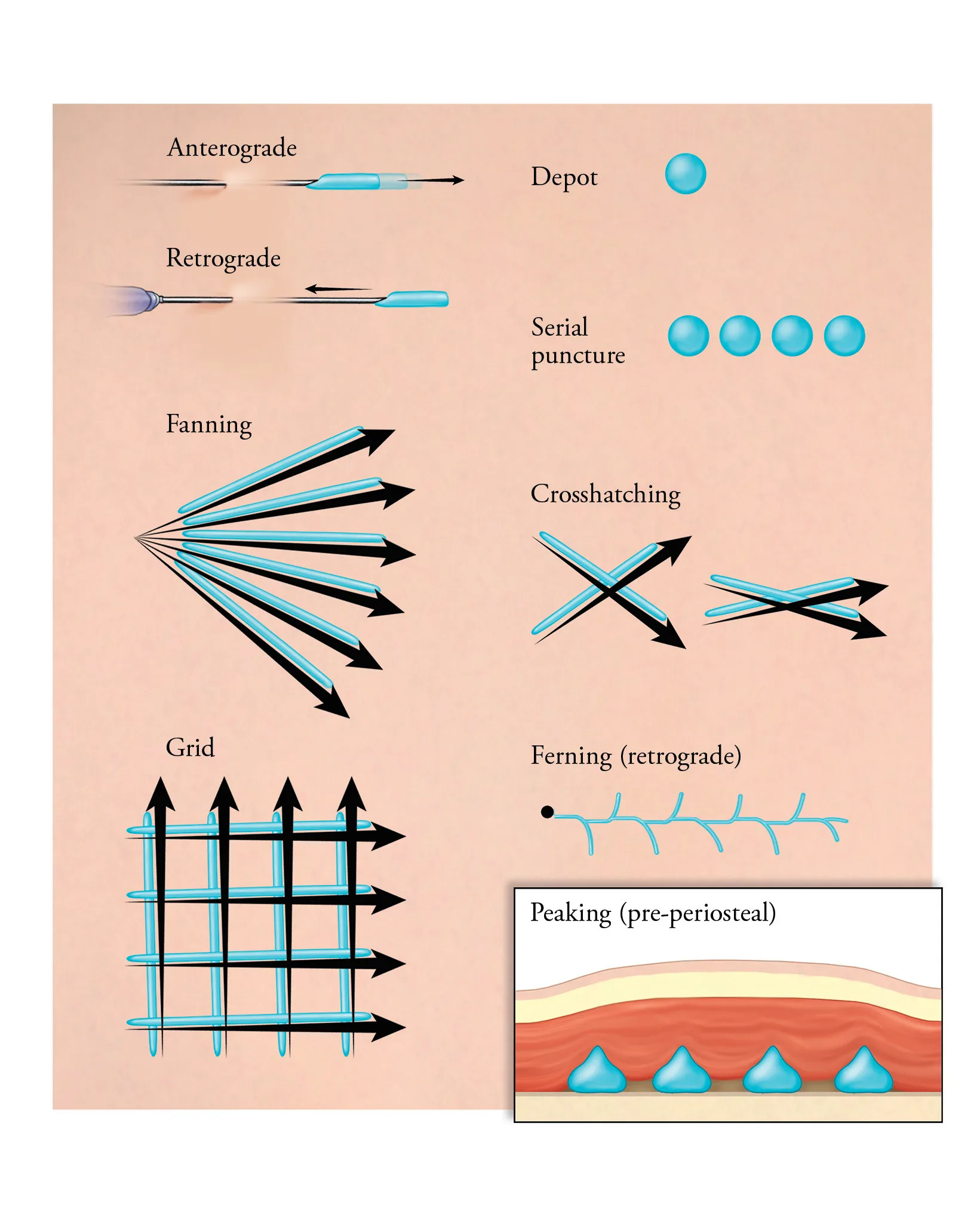 Fig 1. Labelled schematic of the neutral injection gestures: anterograde and retrograde linear threading, depot, serial puncture, fanning, crosshatching, grid, ferning (retrograde) and peaking (pre-periosteal).