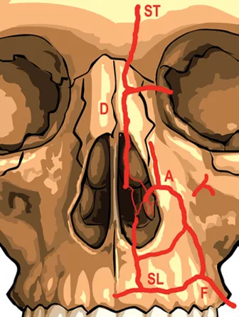 Fig 4. The midface arterial network that makes an aesthetic injection potentially blinding: the facial artery (F) → superior labial (SL) → angular (A), anastomosing with the dorsal nasal (D) and supratrochlear (ST) branches of the ophthalmic system.