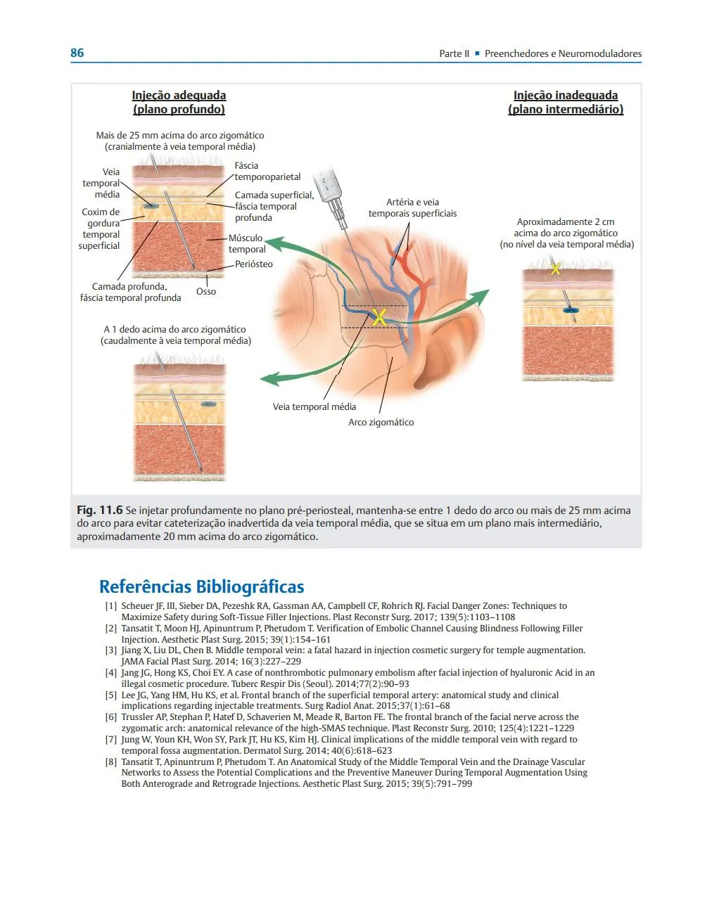 Fig 2. Temple cross-section: correct deep pre-periosteal plane (>25 mm above, or one finger-breadth above, the zygomatic arch) versus the forbidden intermediate plane at the level of the valveless middle temporal vein ~20 mm above the arch.