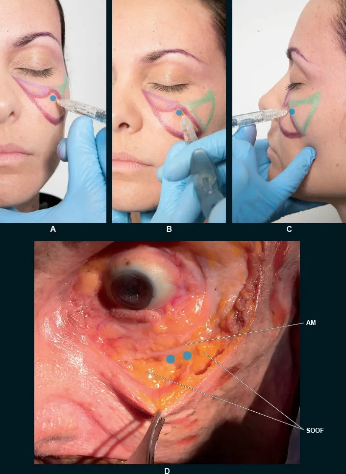 Fig 3. Supraperiosteal needle technique (A–C, model, frontal and profile) and its cadaver correlate (D): a 27G × 13 mm needle to bone at the anterior-malar/zygomatic transition, the deposit between the SOOF and the arcus marginalis, staying lateral to the infraorbital foramen.