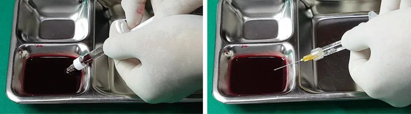 Fig 6. Aspiration in vitro: a 27G needle on the syringe draws blood in ~1 second (left), while a 25G cannula draws none even after 10 seconds (right) — the false-negative that makes a negative aspirate unreliable, especially with a cannula.