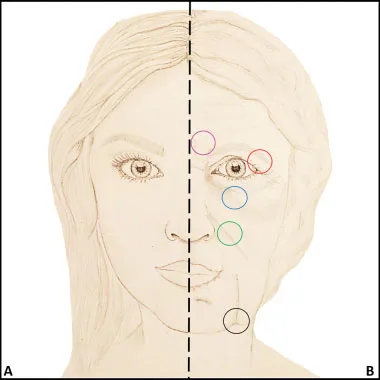 Fig 8. Schematic youthful (A) versus aged (B) face: the glabellar region wrinkles from procerus/corrugator/depressor supercilii action (upper marked circle), the ROOF sags (periorbital circle) and the tear trough/SOOF change, mapping the dynamic-to-static and descent components of upper-third aging.
