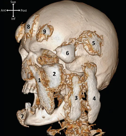 Fig 1. Contrast-CT 3D reconstruction with the superficial (subcutaneous) fat compartments injected and numbered; in the forehead the superficial central forehead compartment (8) and the bilateral superficial lateral forehead compartments (9) sit between skin and frontalis, with the superficial superior (5) and inferior (6) temporal compartments laterally.