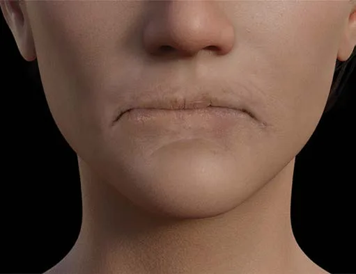 Fig 5. Aged female lower face: thinned, poorly projected lips with an effaced vermilion border, faded Cupid's bow, radial perioral ("barcode") rhytids, a downturned oral commissure and an incipient mental crease.