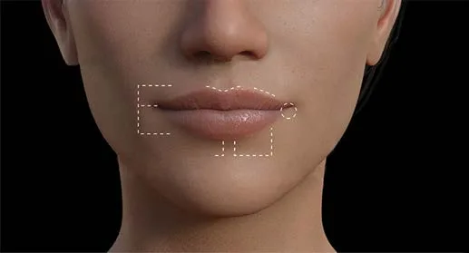 Fig 6. Female lower face marked for assessment: dashed rectangles map the aesthetic subunits of the upper and lower lip and the philtral/commissure zones, with a circle at the oral commissure marking the high-risk entry point.