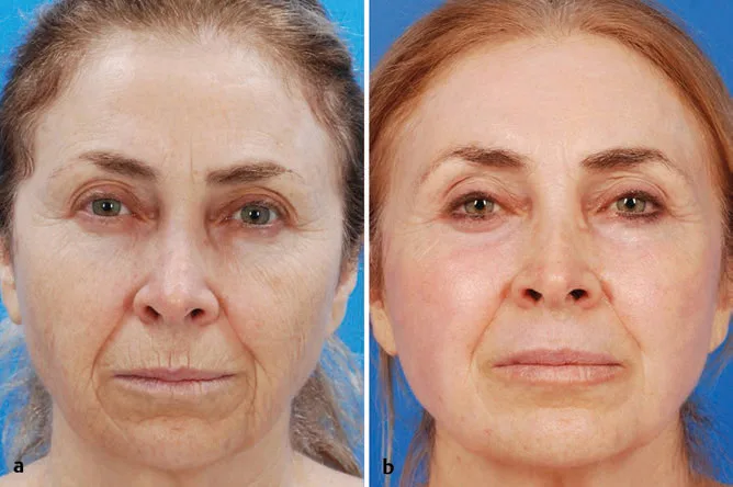 Fig 9. Before (a) and after (b) full-face female views showing marked effacement of perioral and mid-facial rhytids after full-field erbium:YAG resurfacing, with smoother perioral skin and reduced radial lip lines.