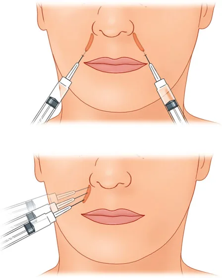 Fig 7. Line-drawing of two perioral injection strategies: top, discrete serial-puncture/linear deposits at the upper-lip and nasolabial junction with the syringe near-perpendicular; bottom, a fanning technique from a single entry redirecting the needle through multiple mid-dermal pathways.