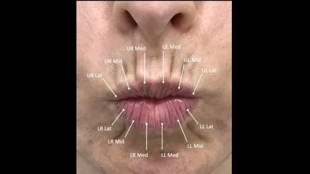 Fig 1. Frontal view of the pursed lips with the intralabial compartment map: six anterior compartments per lip (upper right/left and lower right/left, each Medial · Middle · Lateral), separated by vertical septa; the central compartments are the largest and taper toward the commissures.