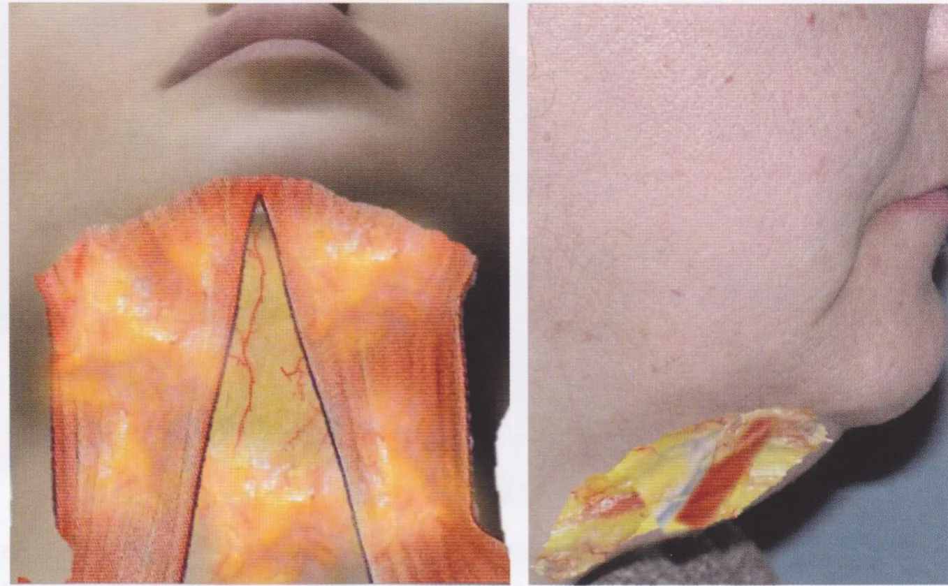 Fig 4. Two-panel danger-zone dissection: left, the reflected upper-lip skin exposes vertical arteries ascending in the philtrum toward the columella and nasal base; right, a tissue flap at the oral commissure marks where the labial arteries enter the lip ~1 cm from the corner of the mouth.