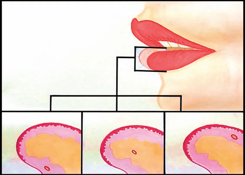 Fig 2. Schematic of the lower lip in profile with a boxed cross-section magnified into three panels showing the labial artery (red lumen) in its three positions relative to orbicularis oris: submucosal (near the wet mucosa, deep to muscle), intramuscular (between the two muscle laminae), and subcutaneous (near the skin).