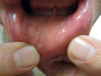 Fig 13. Everted lower lip held between the operator's fingers, exposing the wet mucosa with a discrete submucosal nodule and mild pigmentary change, a retained/inflammatory HA nodule after lip augmentation.