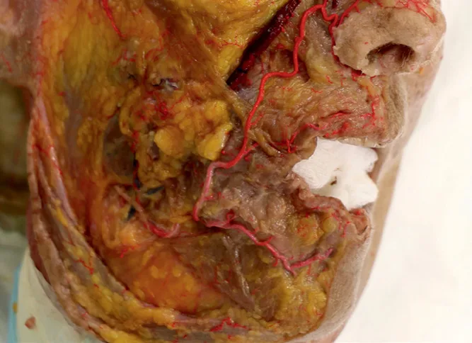 Fig 3. Cadaver dissection of the lower face and lip with the arterial tree injected (red): the facial artery ascends lateral to the commissure and gives the labial arteries, which course toward the midline just deep to the vermilion; a marker sits at the modiolus region.