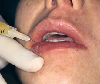 Fig 8. Close-up of a lower-lip injection: a fine needle enters the wet-dry junction from the mucosal side while the operator's gloved finger everts and stabilizes the lip; the thread is placed low in the vermilion for projection.