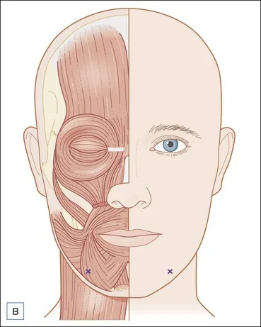 Fig 10. Split illustration of the lower face: the left half shows the perioral mimetic musculature (orbicularis oris, depressor anguli oris, depressor labii inferioris, mentalis and the levator complex), the right half the surface with paired injection marks (×) low on the chin/jaw margin for the depressor/mentalis targets.