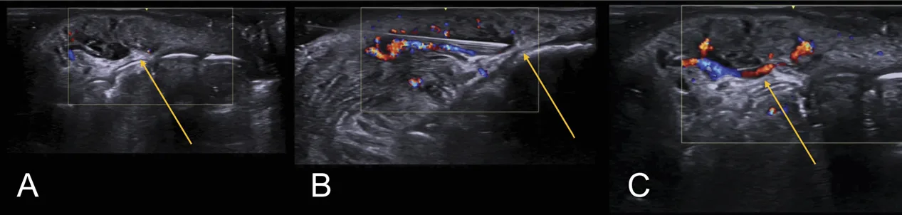 Fig 14. Three-panel color-Doppler ultrasound of a lower-lip vascular occlusion: (A) the occluded segment with no flow and an anechoic filler deposit (arrow); (B) the ultrasound-guided hyaluronidase needle entering the vessel; (C) restored color flow after dissolving the obstruction.