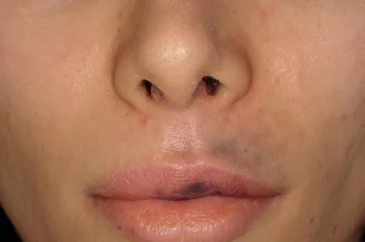 Fig 12. Perioral close-up showing a dusky, violaceous discoloration over the left upper lip and philtrum with early livedo, the clinical picture of an evolving labial-artery vascular occlusion after HA filler.