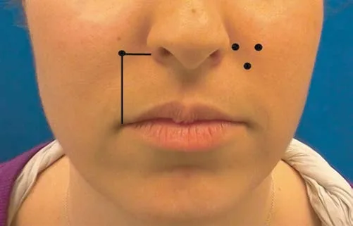 Fig 11. Female lower face marked for a gummy-smile plan: an L-shaped measurement bracket on the left cheek and three dots lateral to the right ala nasi marking the convergence point (Yonsei/Suber) for LLSAN/LLS/zygomaticus-minor injection.